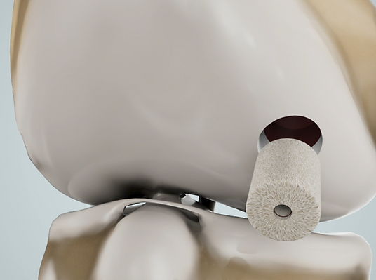 Articular Cartilage Regeneration