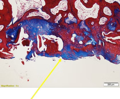 CoreTlage 4.5 months